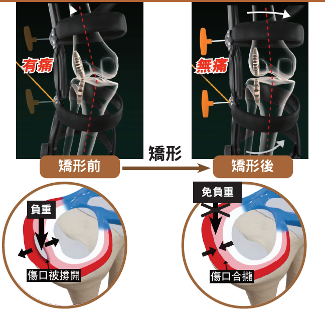 半月板